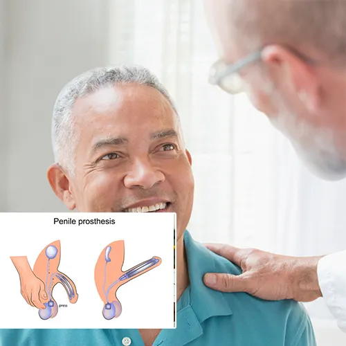 Understanding Age and Penile Implant Surgery with  Urology Surgery Center 


